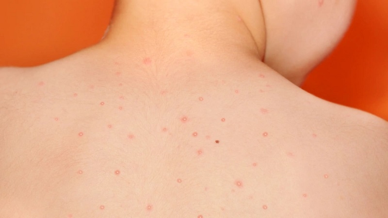 Piojos, verrugas y moluscos contagiosos: Cómo enfrentar a los intrusos del verano